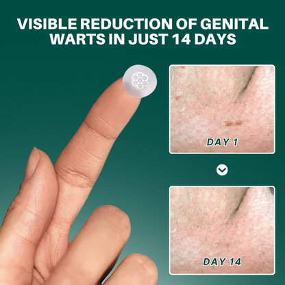 Sumifun® Magnesium MicroPin HPV Genital Wart Removal Patch-Ll