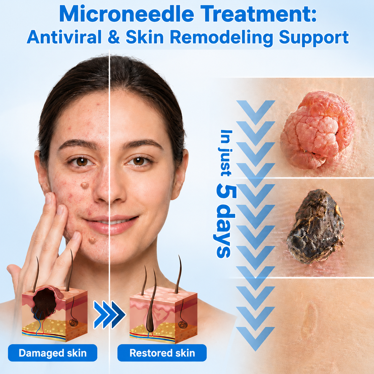Sumifun® 2-in-1 Hydrocolloid Microneedle Patches-Ll