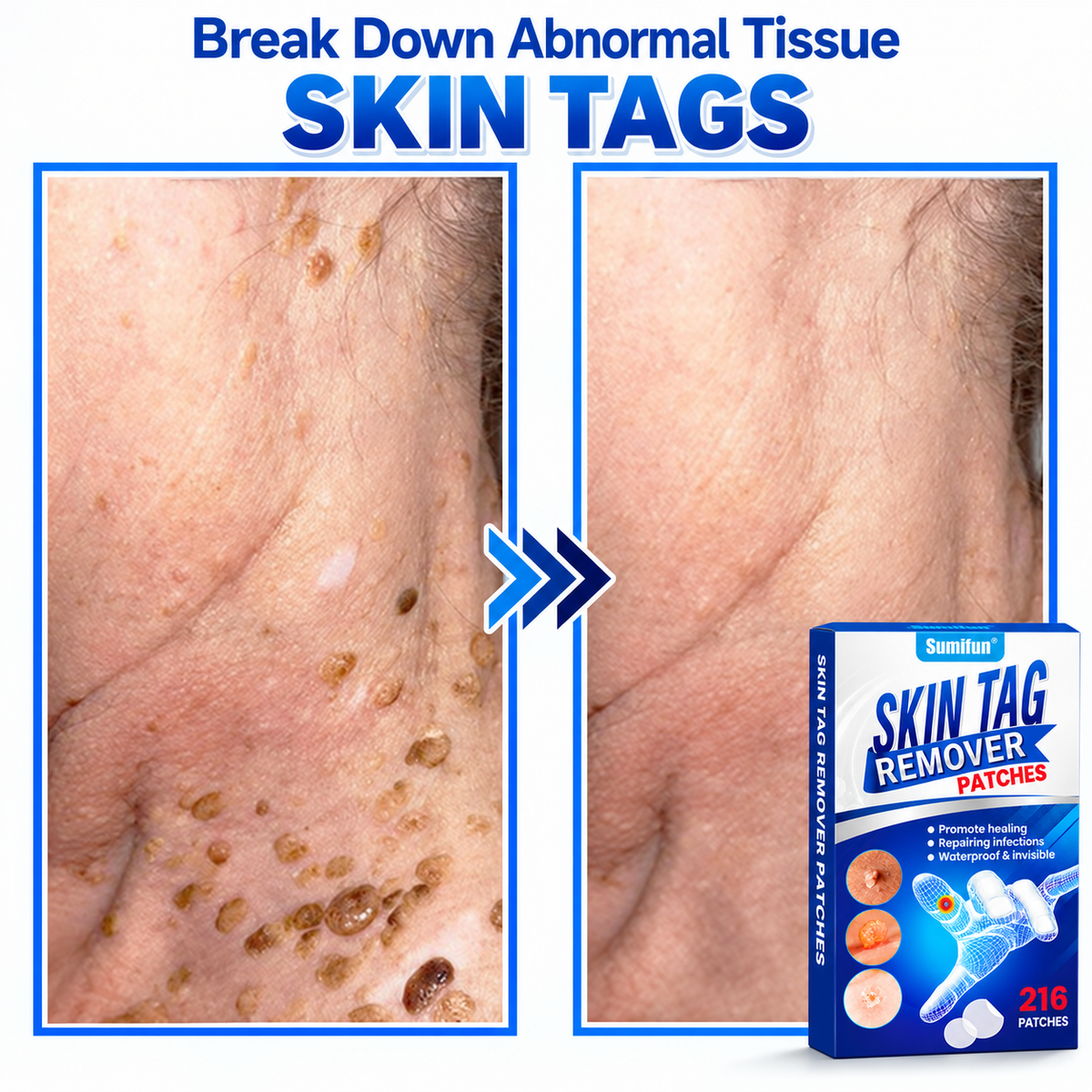 Sumifun® 2-in-1 Hydrocolloid Microneedle Patches-Ll